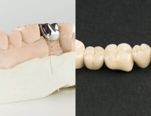 picture of Dental crowns and bridges