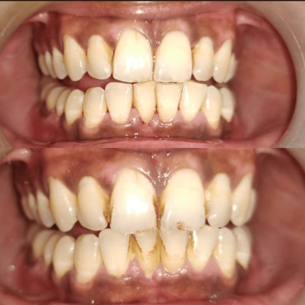 Before and after image of teeth cleaning