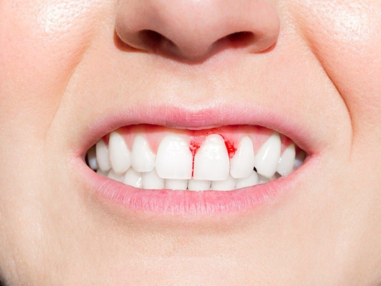 Bleeding Gum Treatment